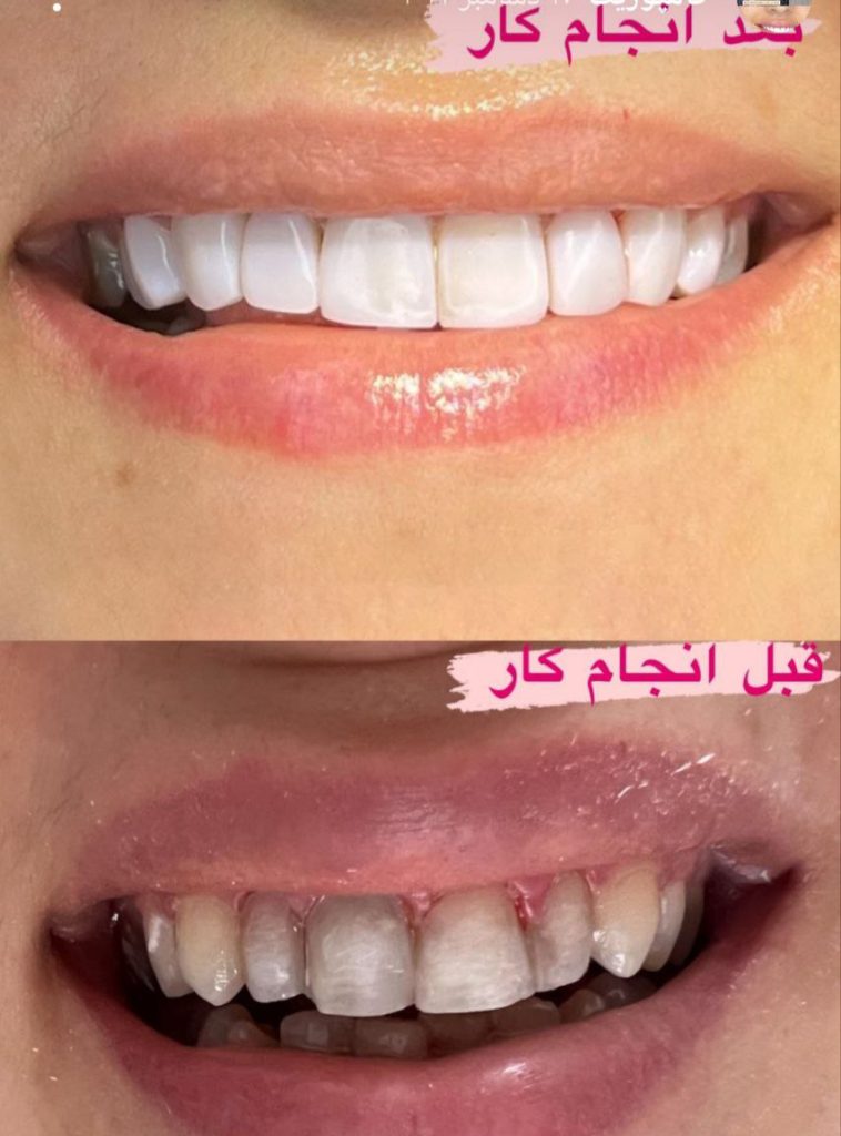 کامپوزیت دندان در کرمانشاه