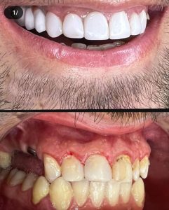 قیمت لمینت دندان در کرمانشاه