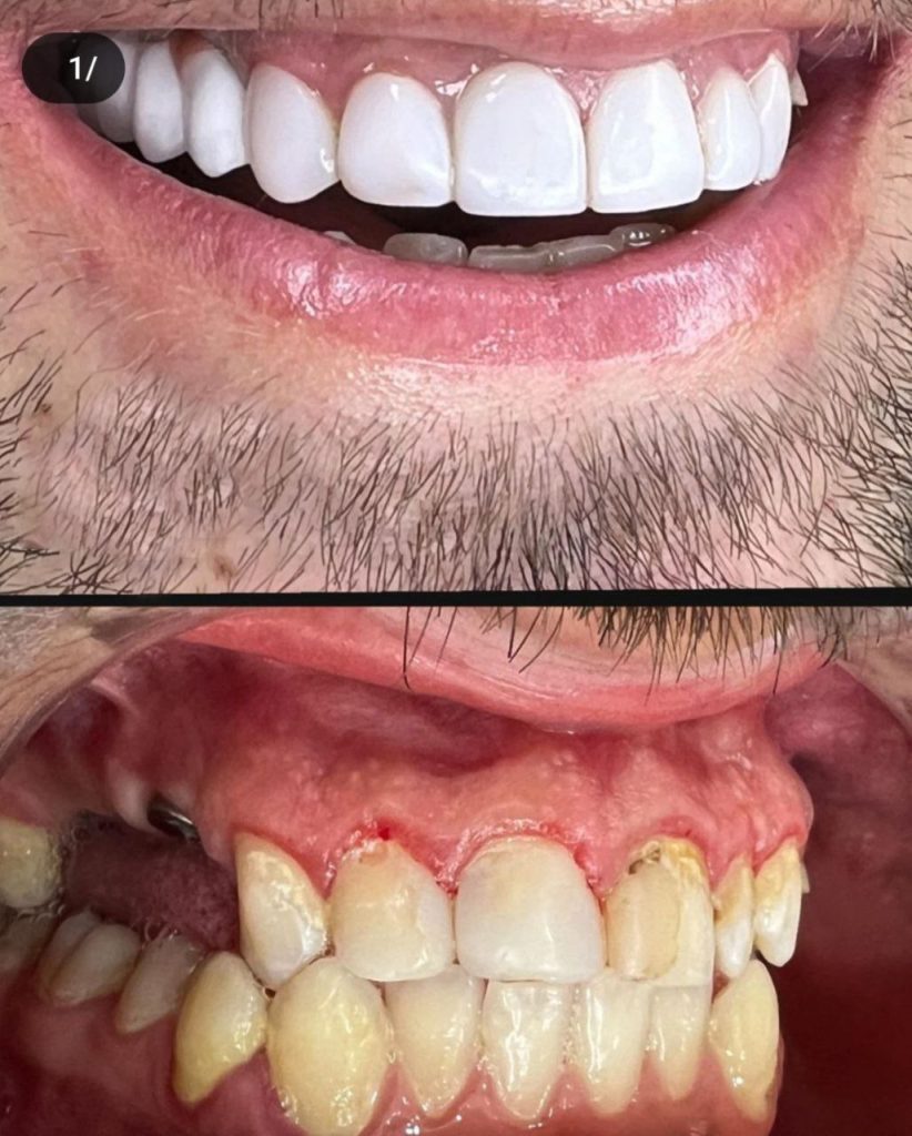 قیمت لمینت دندان در کرمانشاه