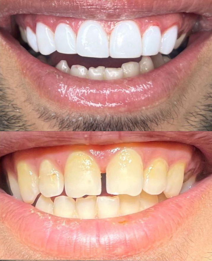 کامپوزیت دندان قیمت کرمانشاه