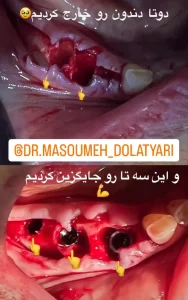 ایمپلنت چیست؟