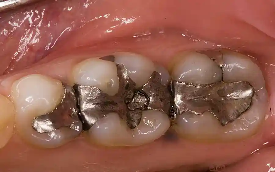 پرکردن دندان دمتر دولتیاری