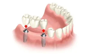 هزینه بریج دندان در کرمانشاه