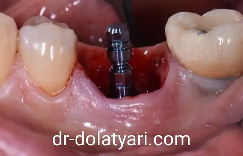 هزینه ایمپلنت دندان در کرمانشاه