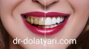 بلیچینگ دندان