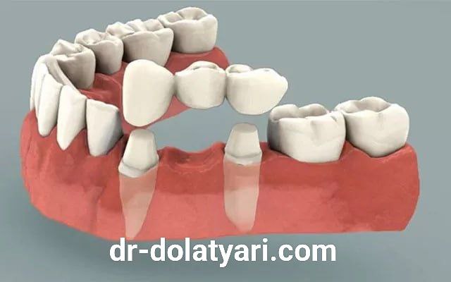 انجام بریج دندان توسط دکتر دولتیاری