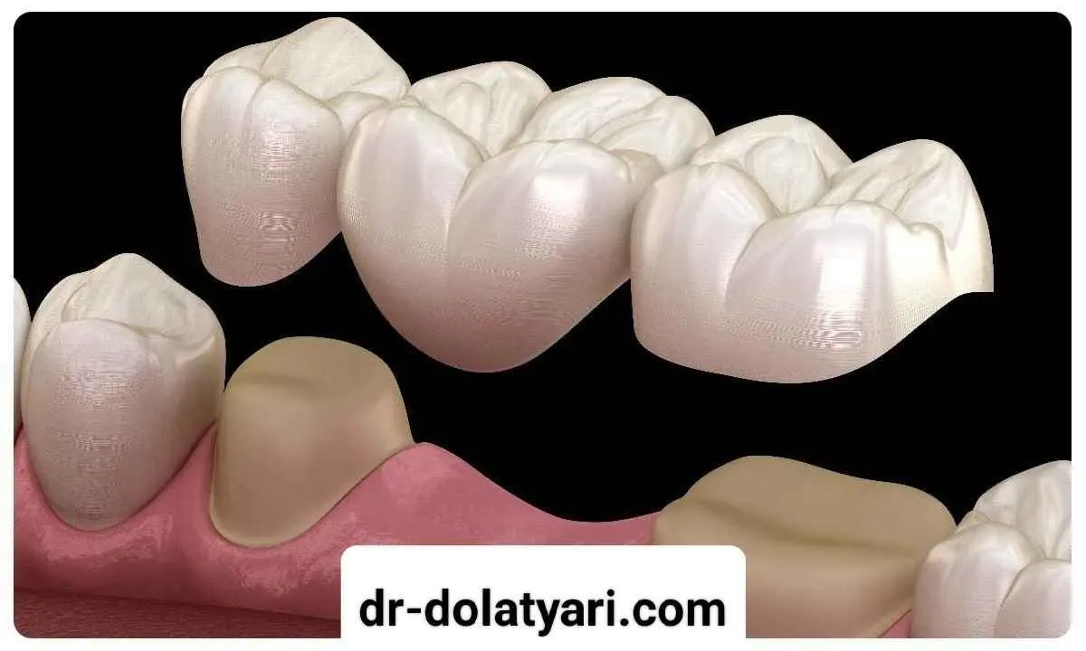 هزینه بریج دندان در کرمانشاه