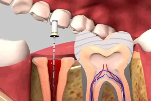 دندانپزشکی دکتر دولتیاری عصبکشی