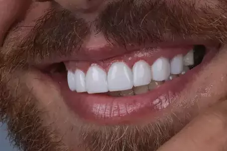 بلیچینگ دندان چیست و چرا اهمیت دارد