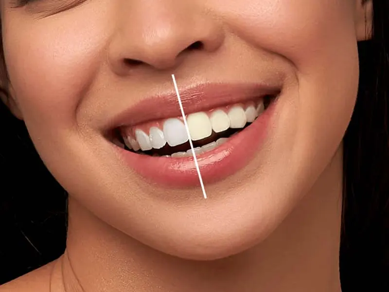 بلیچینگ دندان برای چه افرادی مناسب است