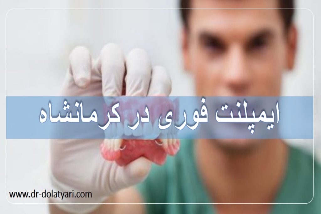 ایمپلنت فوری چیست؟