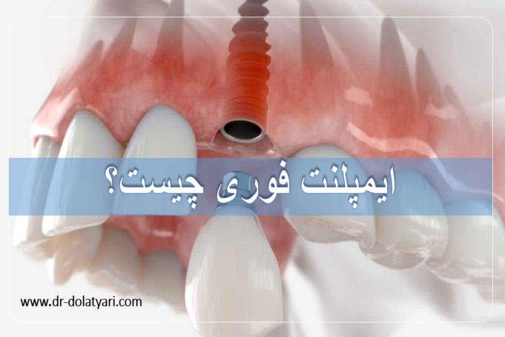 ایمپلنت فوری چیست؟