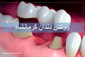 روکش دندان کرمانشاه