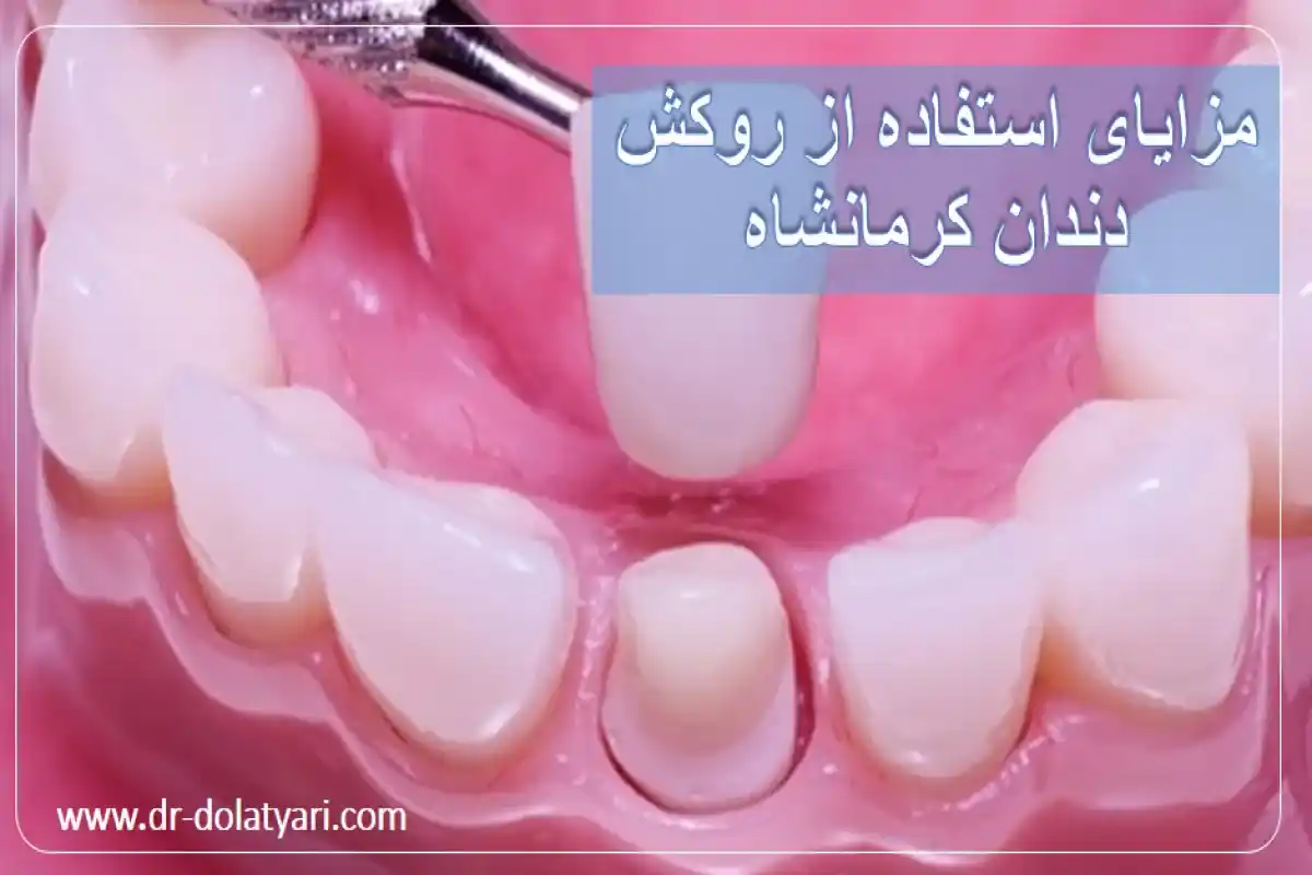 مزایای استفاده از روکش دندان کرمانشاه