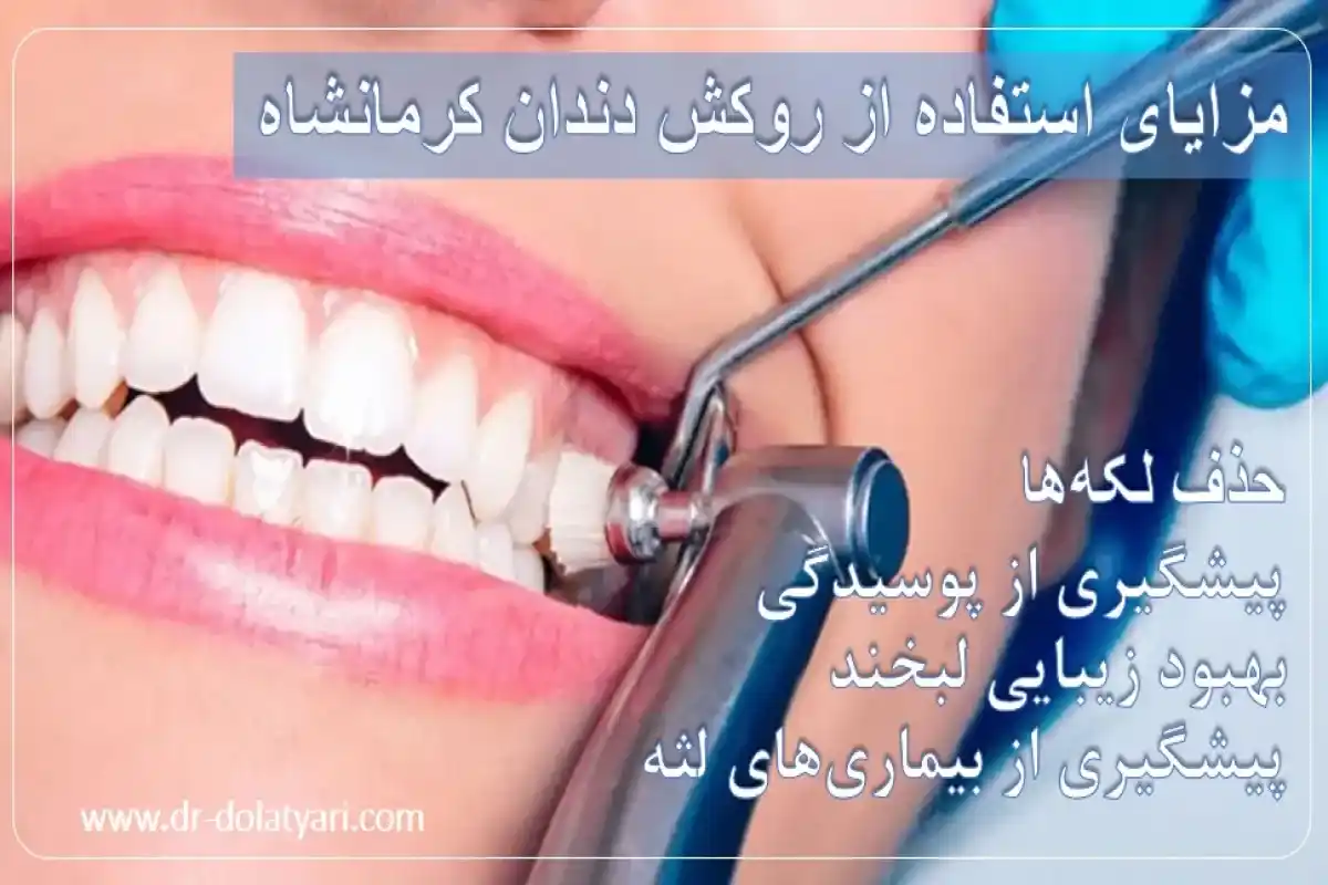مزایای پالیش دندان | پالیش دندان در کرمانشاه