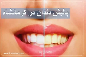 پالیش دندان در کرمانشاه