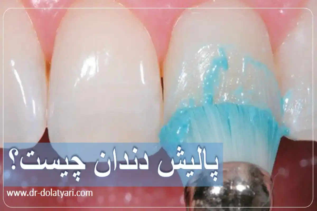 پالیش دندان چیست؟