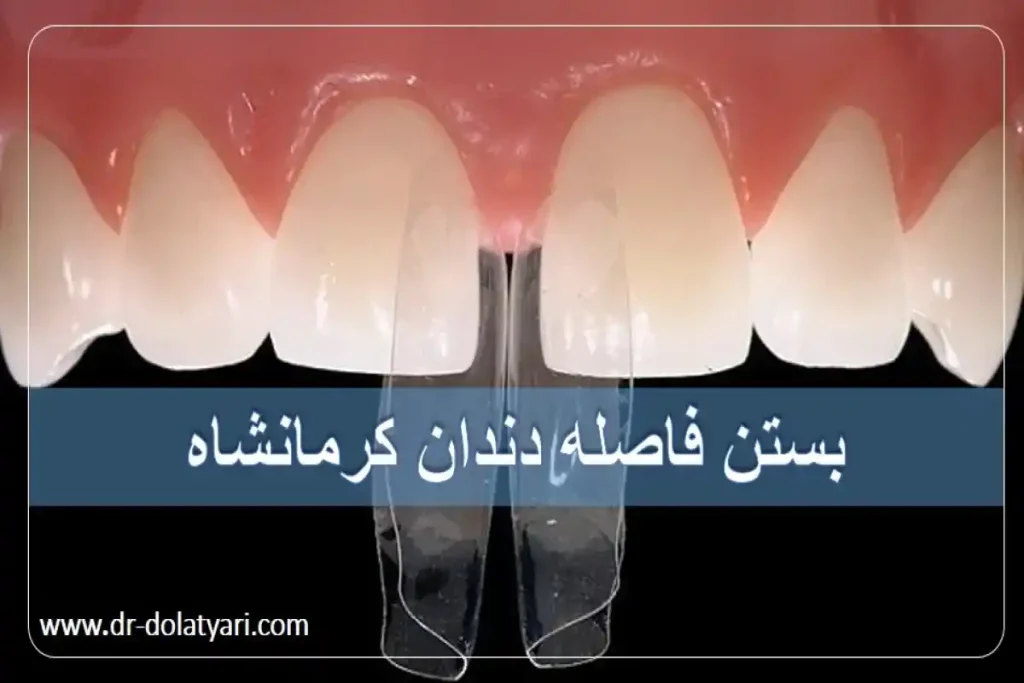 بستن فاصله دندان کرمانشاه