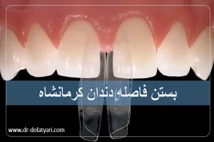 بستن فاصله دندان کرمانشاه