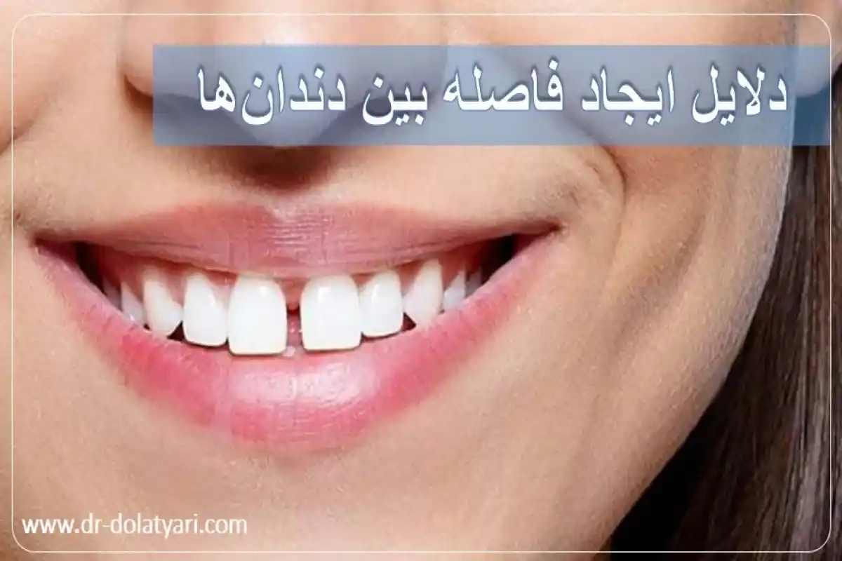 دلایل ایجاد فاصله بین دندان‌ها