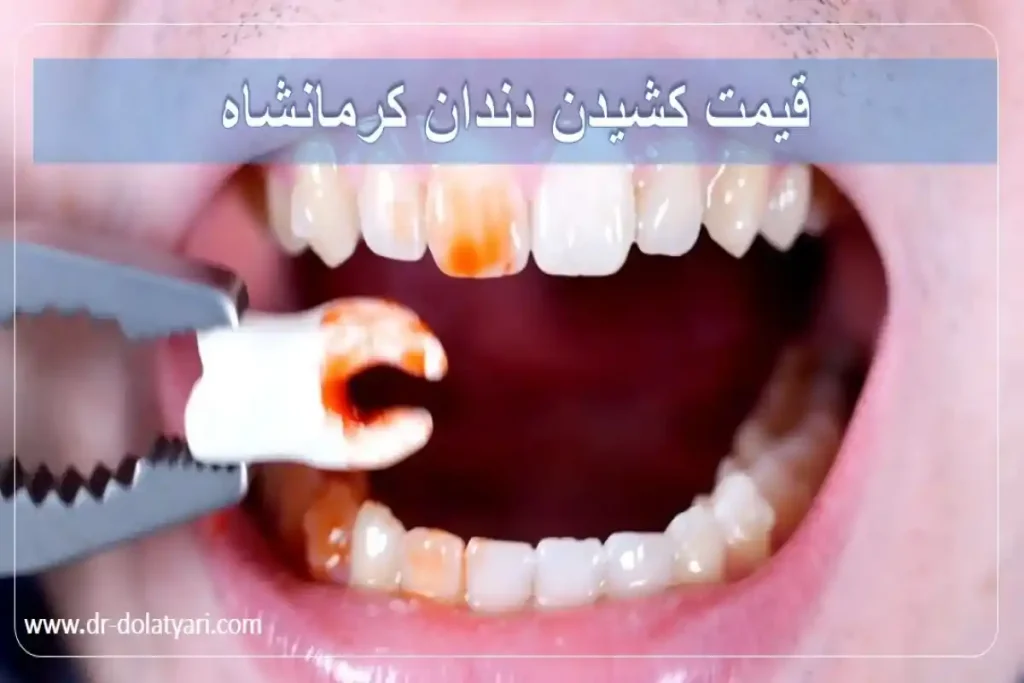 قیمت کشیدن دندان کرمانشاه