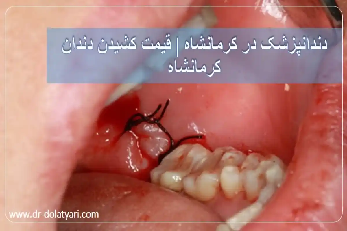 دندانپزشک در کرمانشاه | قیمت کشیدن دندان کرمانشاه