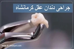 جراحی دندان عقل کرمانشاه