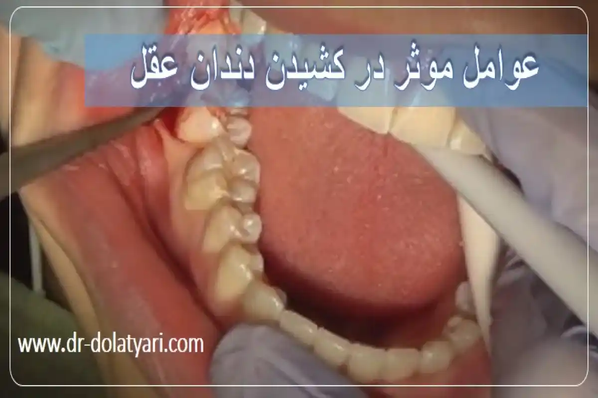 عوامل موثر در کشیدن دندان عقل