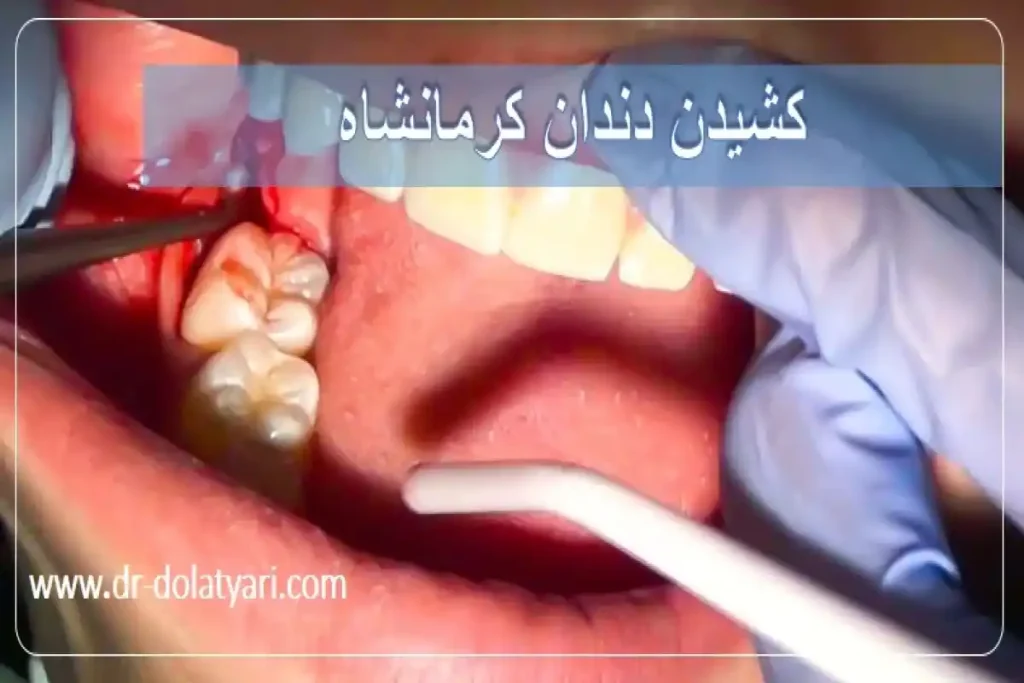 کشیدن دندان کرمانشاه