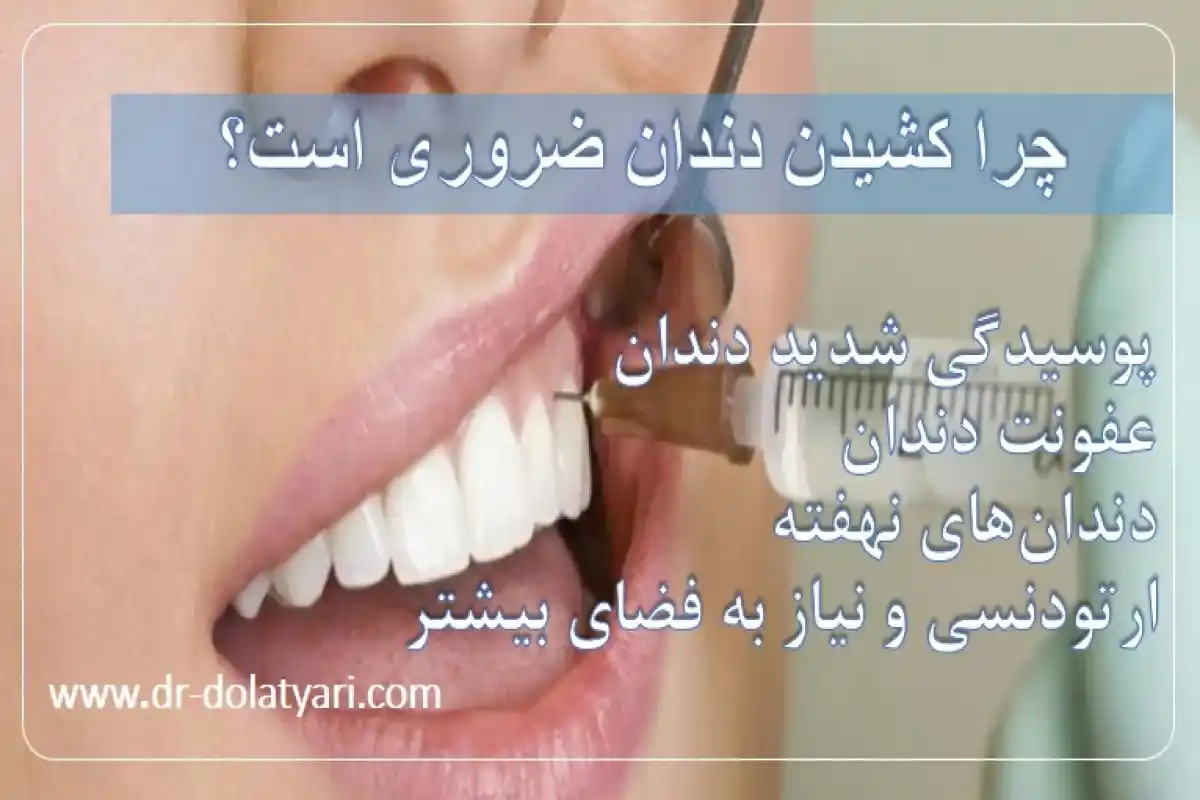 چرا کشیدن دندان ضروری است؟