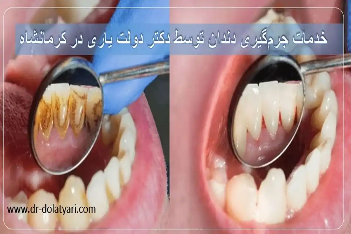 خدمات جرم‌گیری دندان توسط دکتر دولت یاری در کرمانشاه