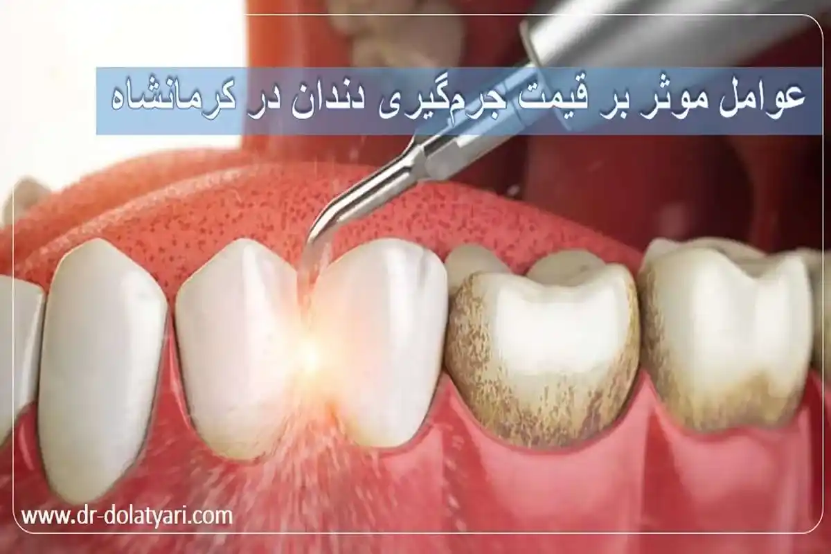 عوامل موثر بر قیمت جرم‌گیری دندان در کرمانشاه