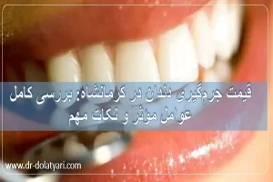 قیمت جرم‌گیری دندان در کرمانشاه: بررسی کامل عوامل مؤثر و نکات مهم