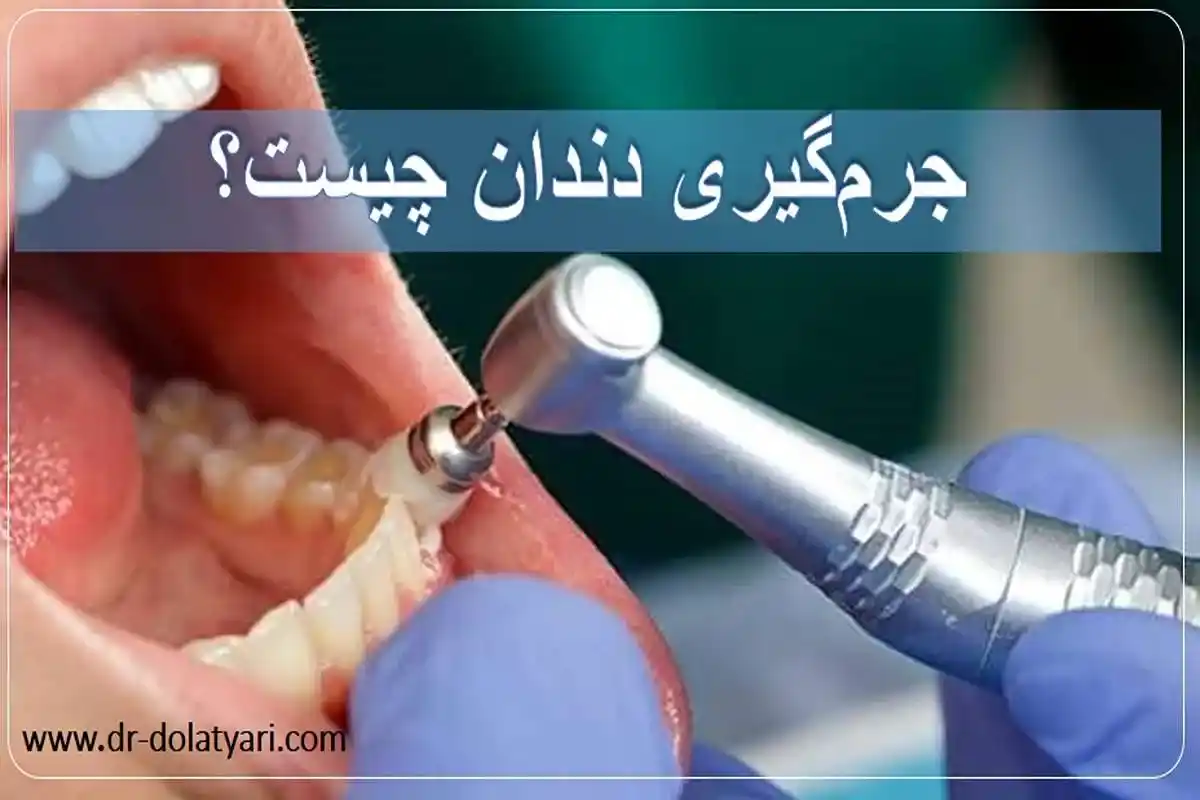 جرمگیری دندان چیست؟