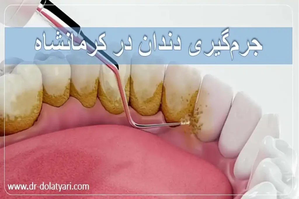 جرمگیری دندان در کرمانشاه