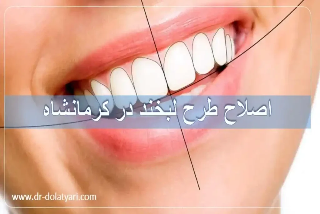 اصلاح طرح لبخند در کرمانشاه