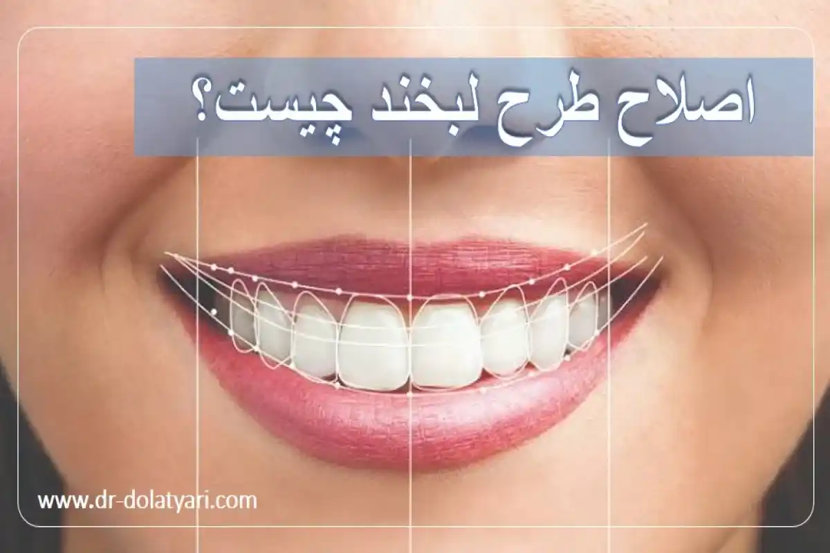 اصلاح طرح لبخند چیست؟