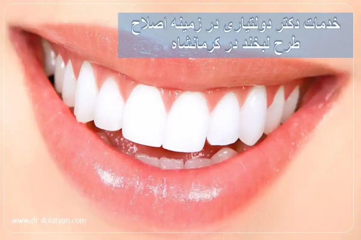 خدمات دکتر دولتیاری در زمینه اصلاح طرح لبخند در کرمانشاه