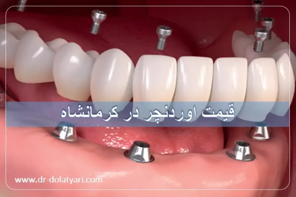 قیمت اوردنچر در کرمانشاه