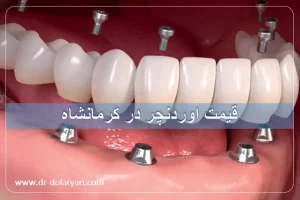 قیمت اوردنچر در کرمانشاه