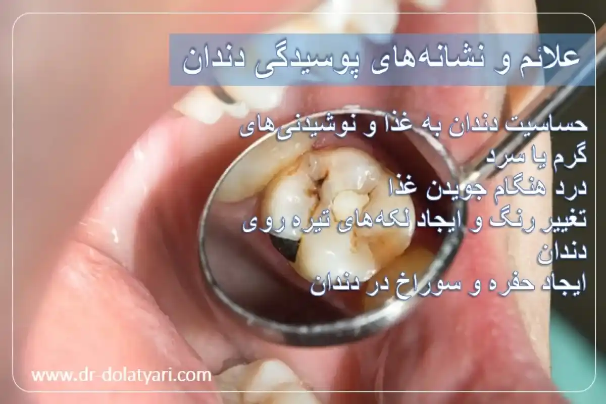 علائم و نشانه‌های پوسیدگی دندان
