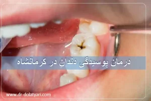 درمان پوسیدگی دندان در کرمانشاه