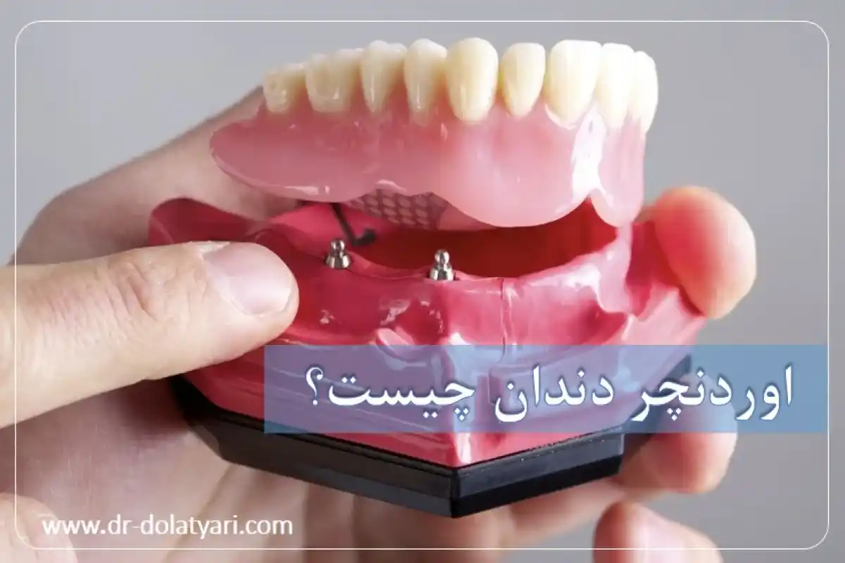 اوردنچر دندان چیست؟