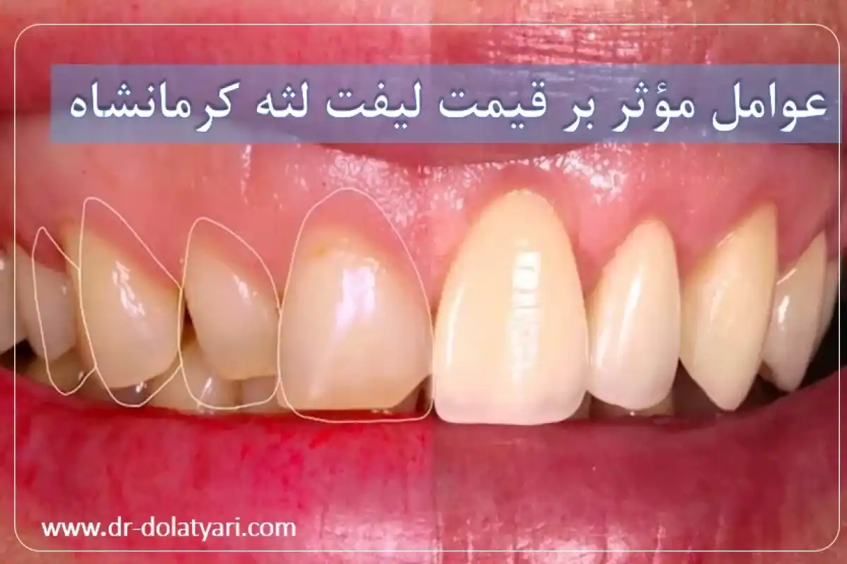 عوامل مؤثر بر قیمت لیفت لثه کرمانشاه