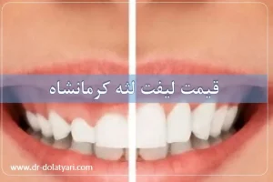 قیمت لیفت لثه کرمانشاه