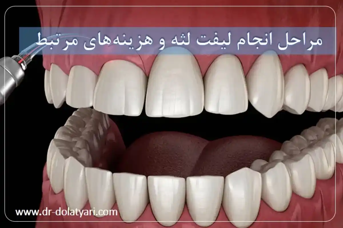 مراحل انجام لیفت لثه و هزینههای مرتبط