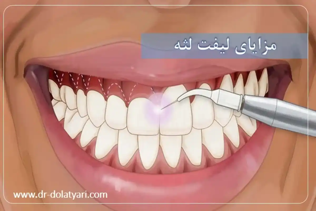 مزایای لیفت لثه