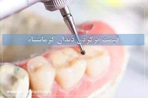 قیمت پرکردن دندان کرمانشاه