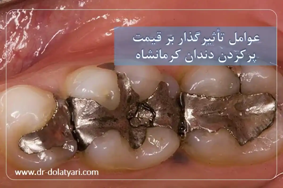 عوامل تأثیرگذار بر قیمت پرکردن دندان کرمانشاه