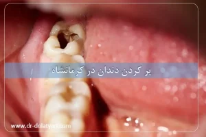 پر کردن دندان در کرمانشاه